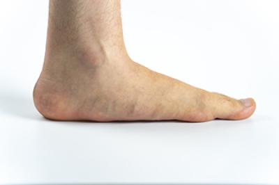 Types of Flat Feet