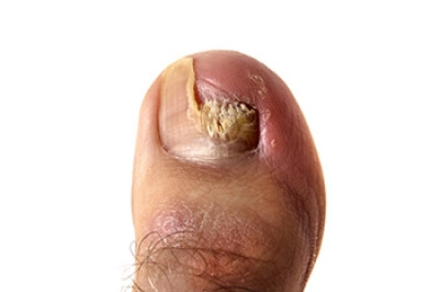 What Is Toenail Fungus?