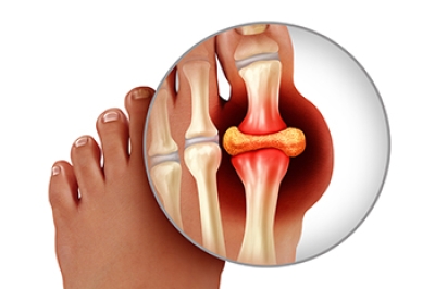 When Is Surgery Needed for Gout?